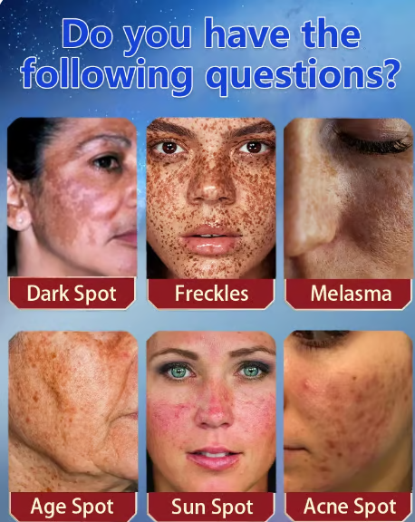 š„Vitamin C Whitening Freckles Face Cream Remove Melasma Dark Spots Lighten Melanin