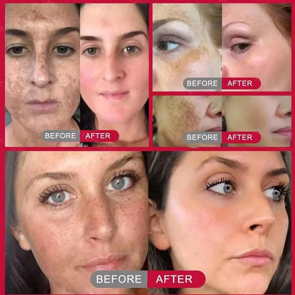 š„Vitamin C Whitening Freckles Face Cream Remove Melasma Dark Spots Lighten Melanin