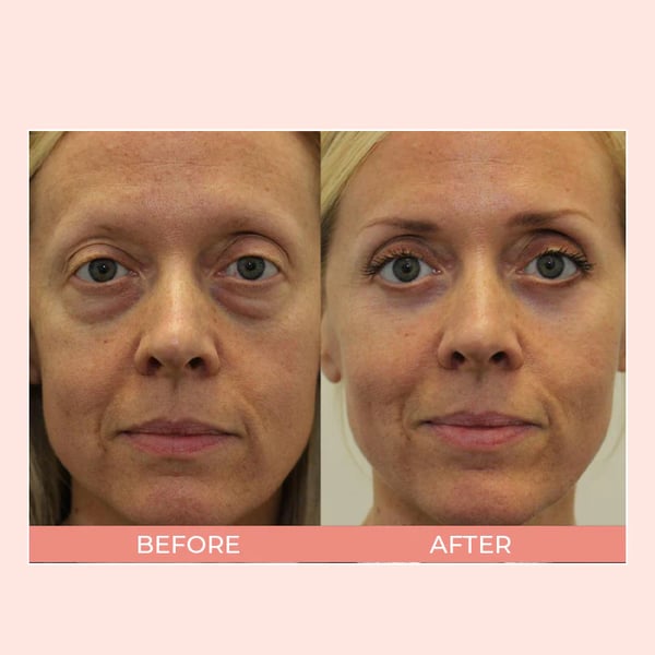 đ„LAST DAY SALE 60% OFFđ„ EIASER Retinol Polypeptide Repair Eye Cream